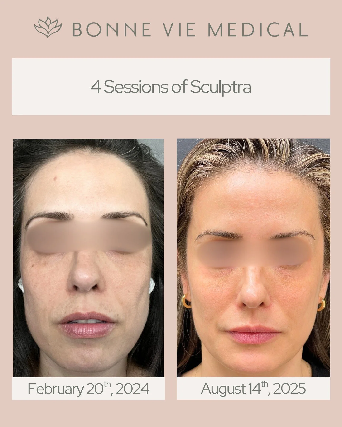 Real results, powered by collagen. ✨
Sculptra helps restore volume, lift, and skin quality gradually for a refreshed, naturally youthful appearance.

#Sculptra #BeforeAndAfter #SkinConfidence #BonneVieMedical #CollagenBoost