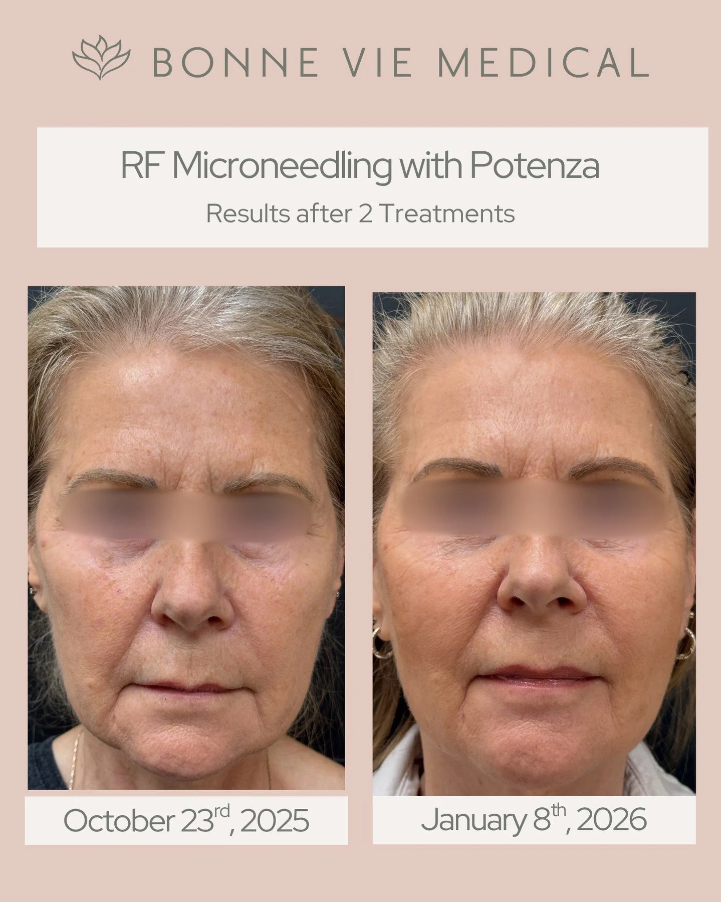 ✨ Real results after 2 treatments ✨

RF Microneedling with Potenza helps tighten, smooth, and restore skin by stimulating collagen deep within.

Firmer, more refined, naturally rejuvenated skin, no surgery needed. 🤍

#Potenza #RFMicroneedling #Befor