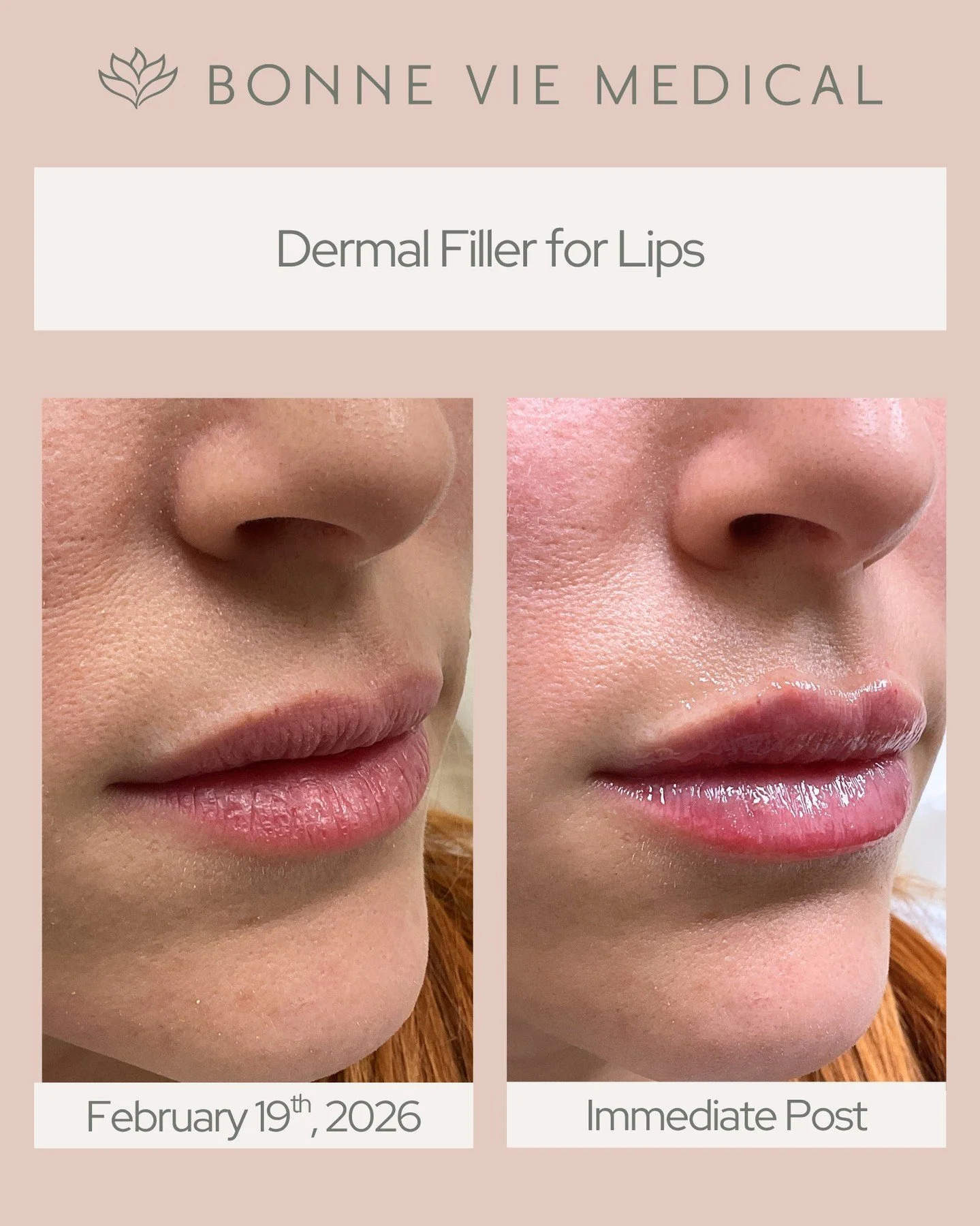 A refreshed, naturally fuller pout 🤍
Designed to enhance shape, restore volume, and keep everything looking soft and balanced.

#NaturalLipFiller #BeforeAndAfter #BonneVieMedical #ConfidenceInEverySmile #MedicalAesthetics