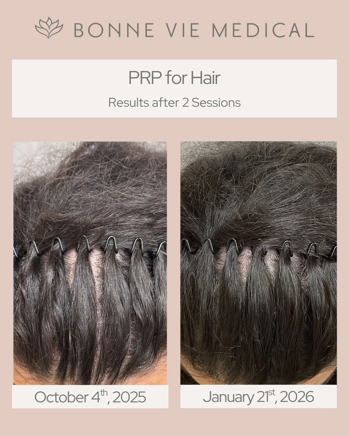 ✨ PRP for Hair Restoration ✨
Results after just 2 sessions 🤍

PRP helps stimulate natural hair growth, improve hair density, and support healthier, fuller-looking hair over time. Consistency is key, and the progress speaks for itself. ✨

#PRPHairRes