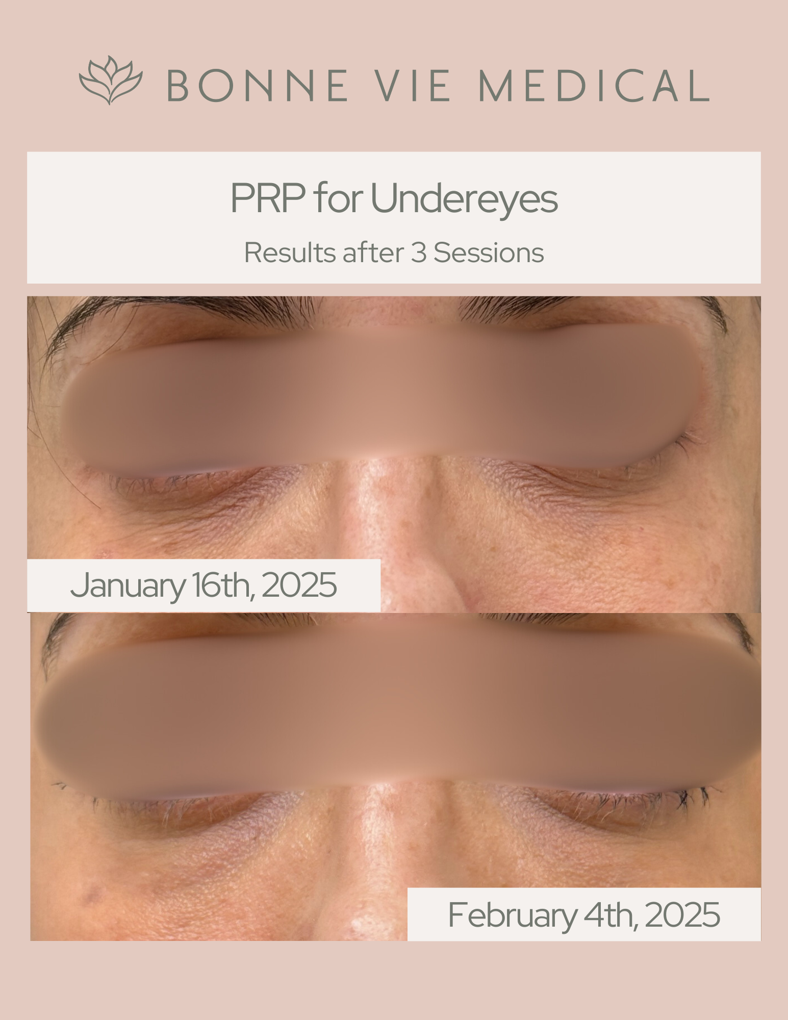 PRP BEFORE AND AFTER.png