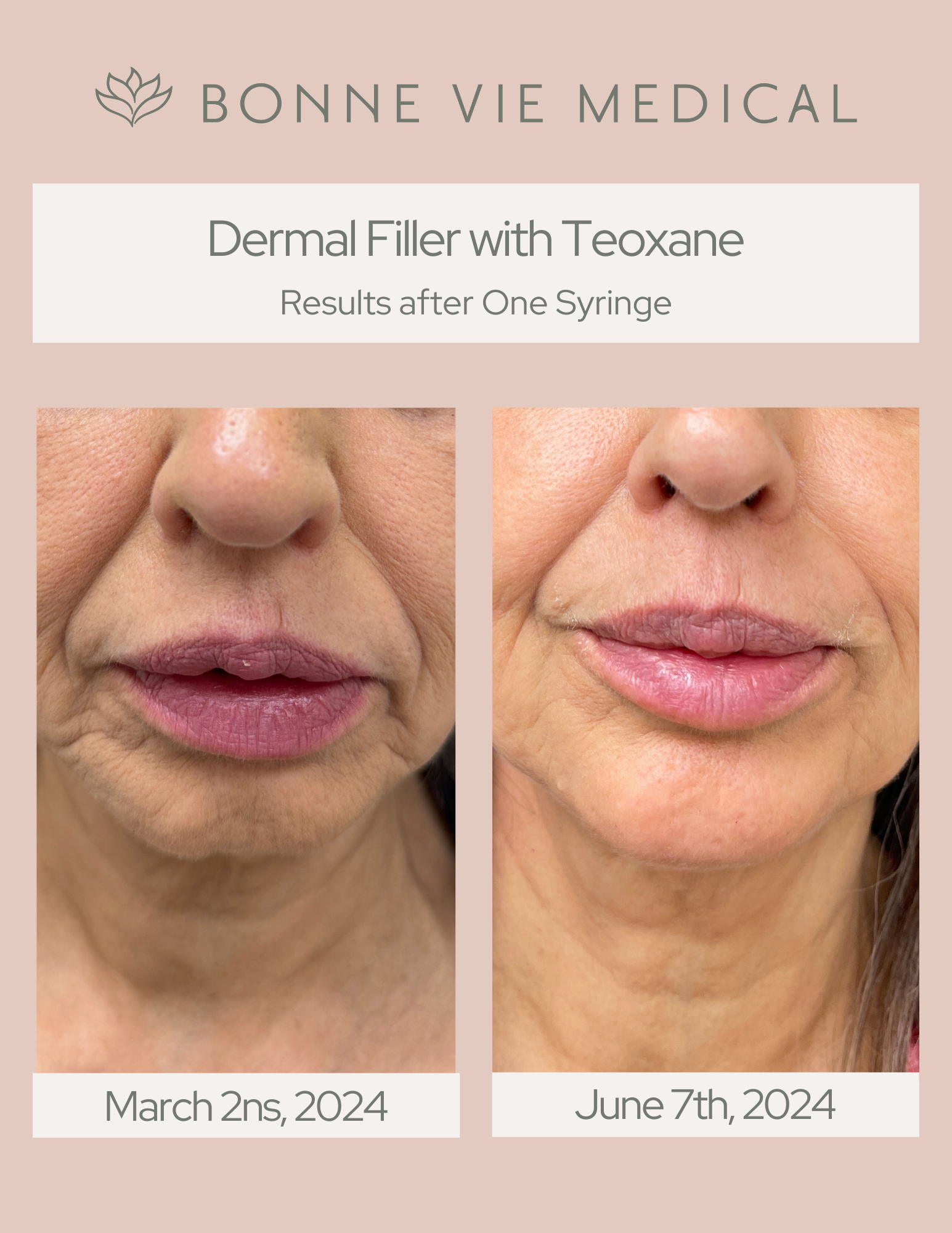 Comparison of before and after dermal filler with Teoxane showing improvement in lip and mouth area from March 2, 2024, to June 7, 2024, by Bonne Vie Medical.