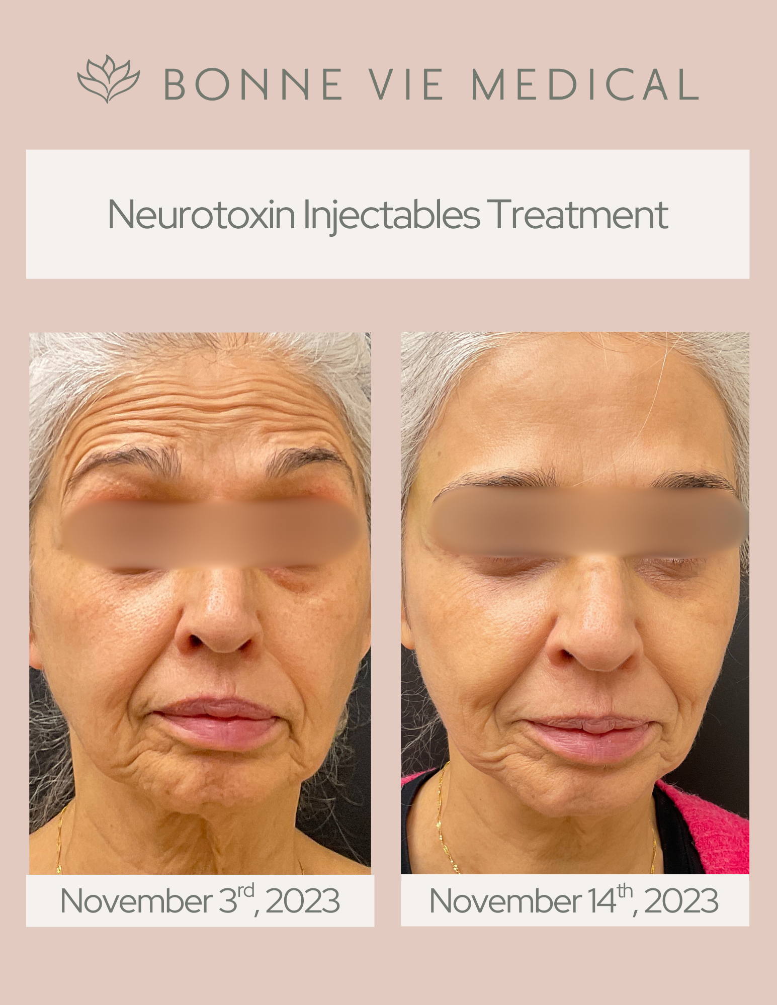 Botox Before After Template.png