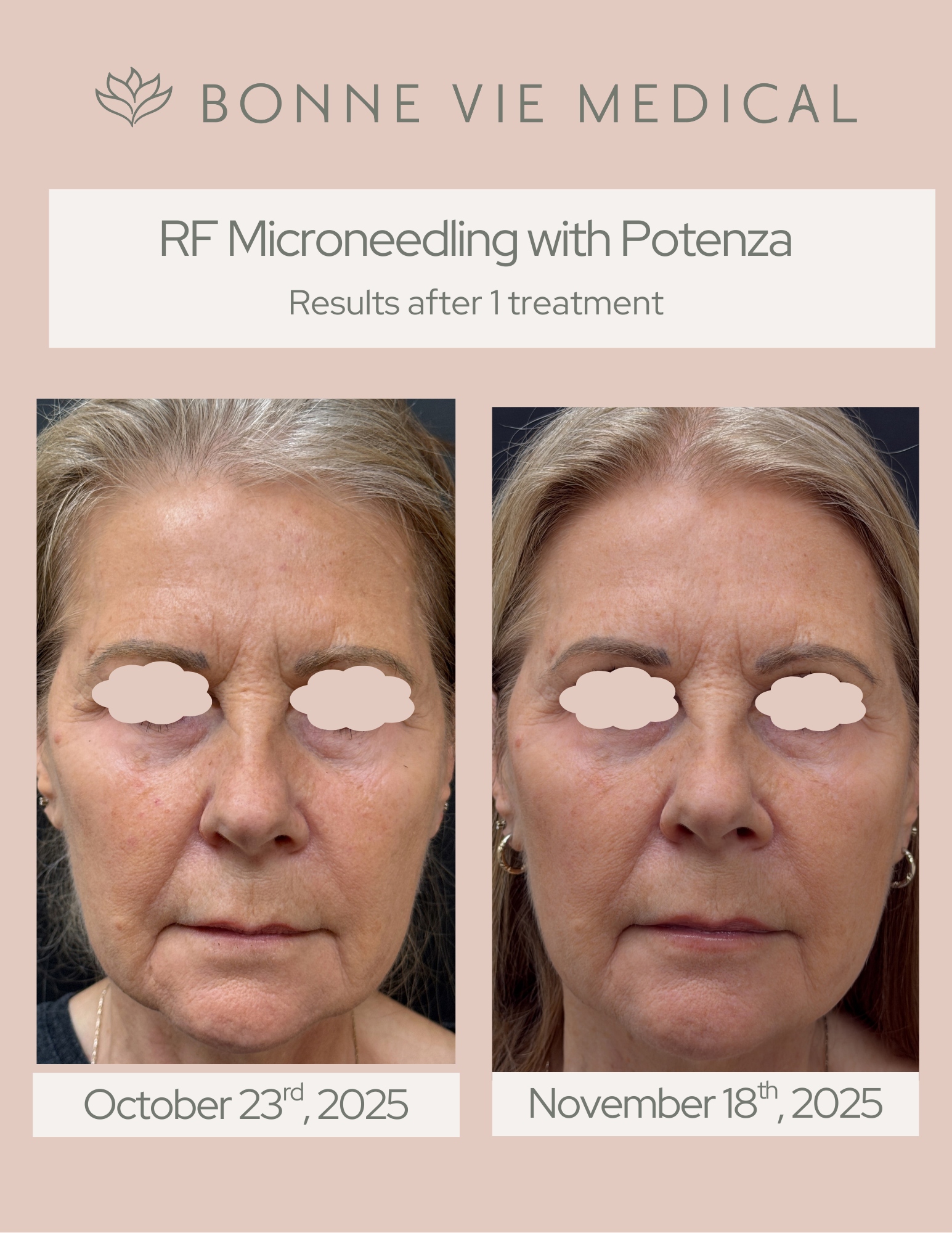 Potenza RF Microneedling BVM Before After Template.png