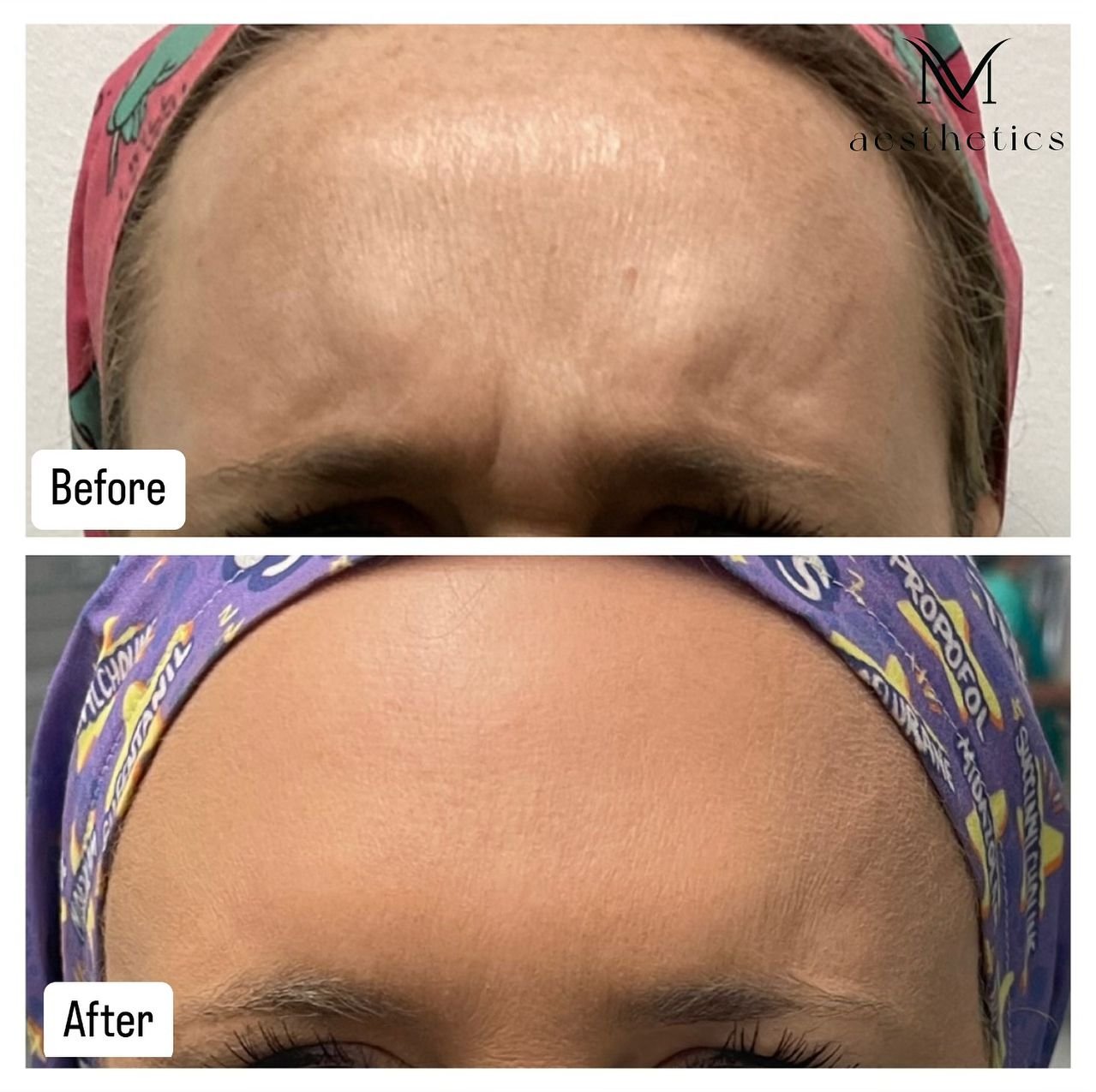 The results are IN 💚💚💚
.
.
&hellip;.and the Dysport is DYSPORTING.  We love her 💯🫶🏼

M. Aesthetics
Andrea Maiberger CRNA, APRN
Contact:
(904) 339-5168
M.AestheticsJax@gmail.com
Booking link in profile ✨

#botox #dysport #tox #toxinjector #fille