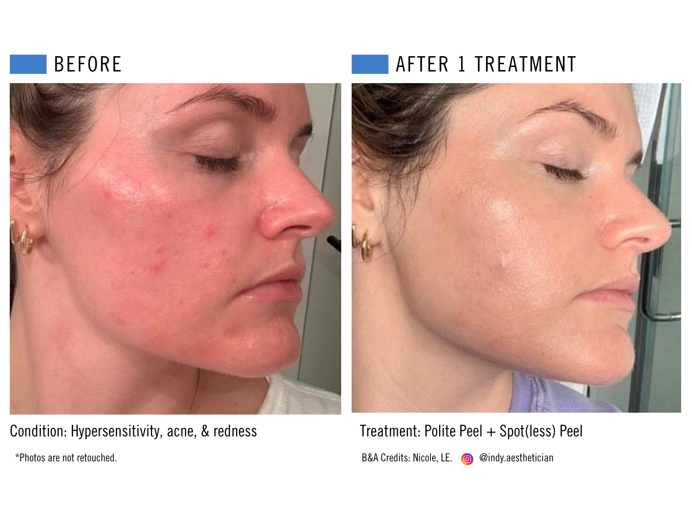 Polite Peel + Spot(less) Peel.png