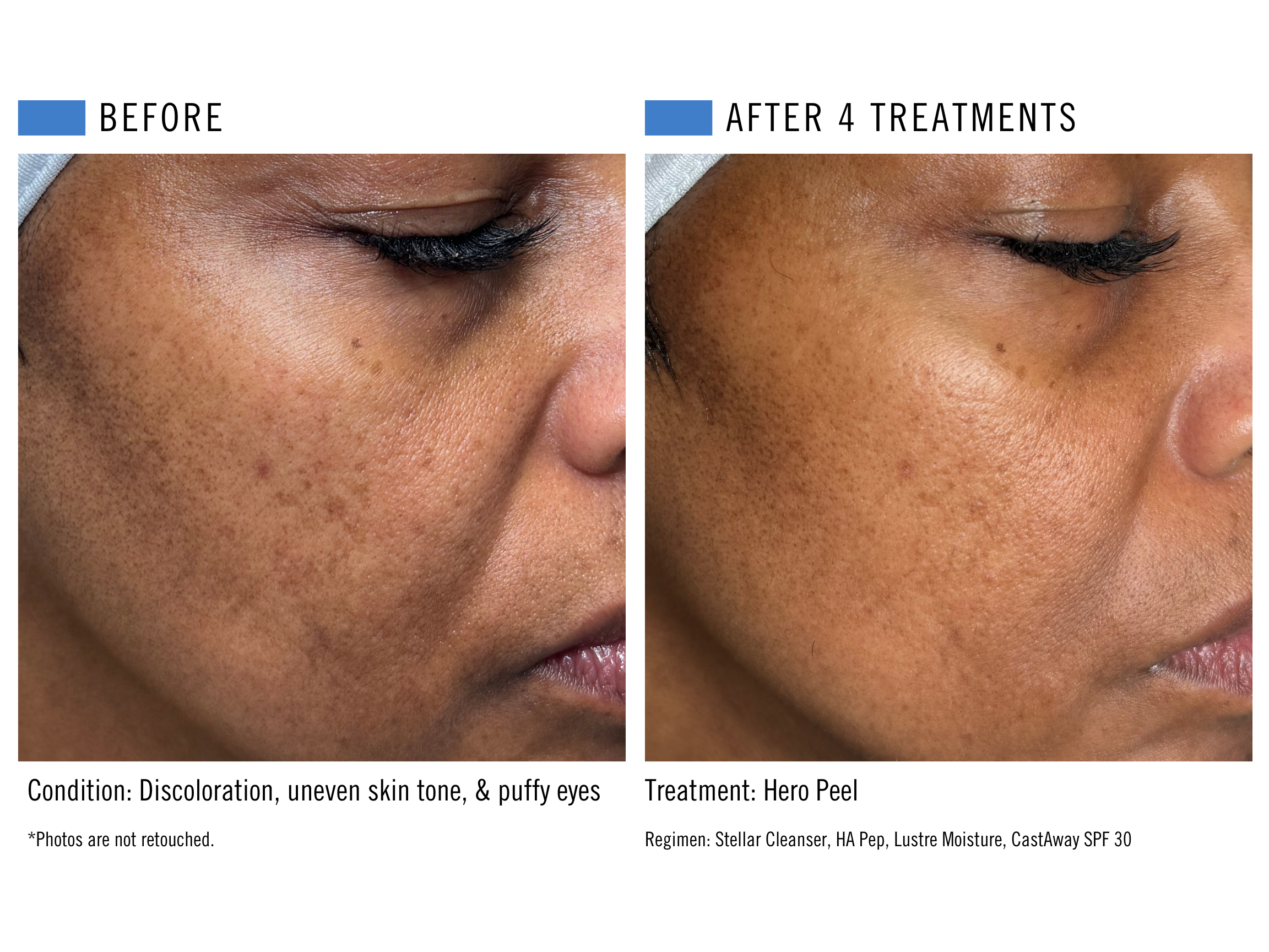 Hero Peel - Uneven skin tone + Puffy eyes.png