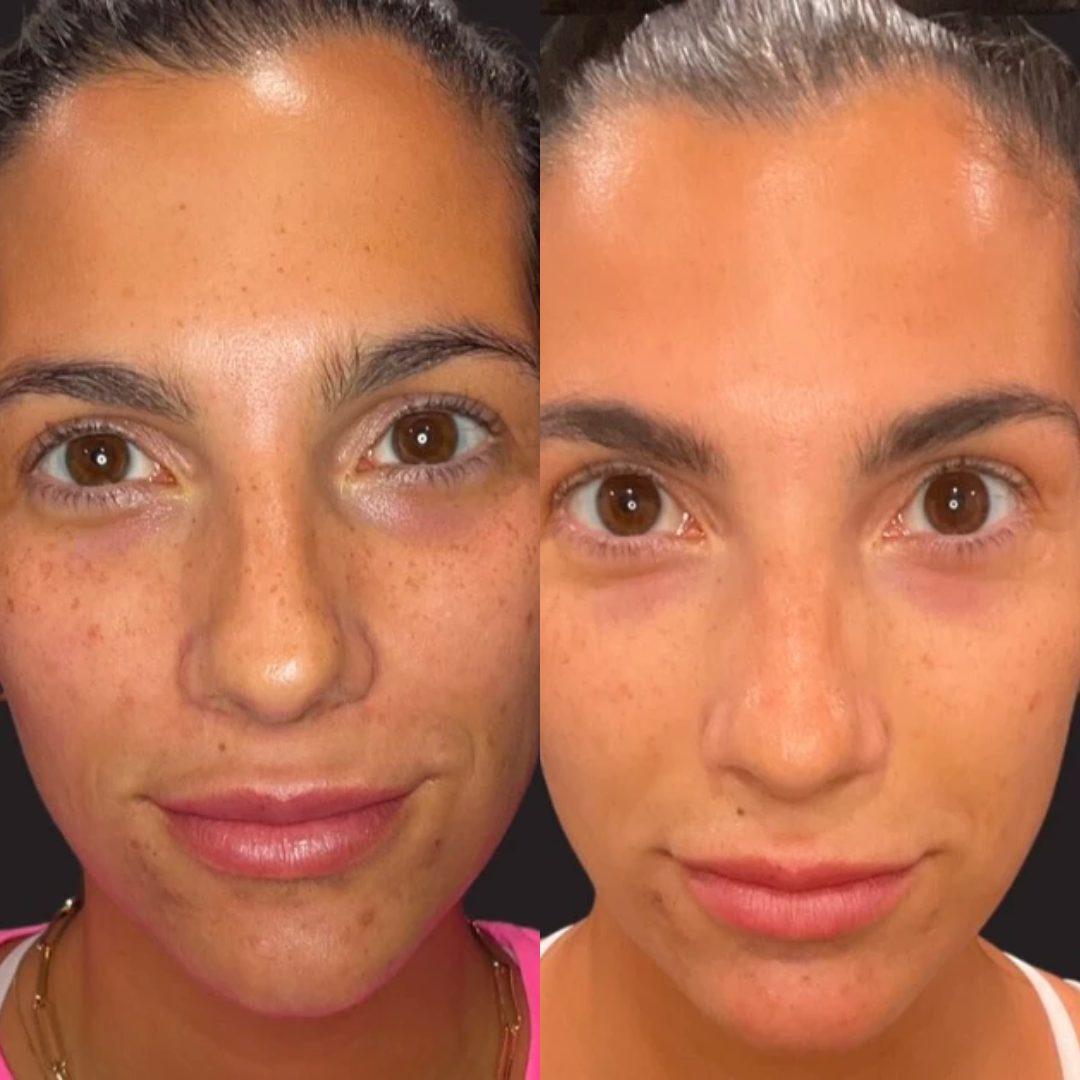 PICO BEFORE & AFTER