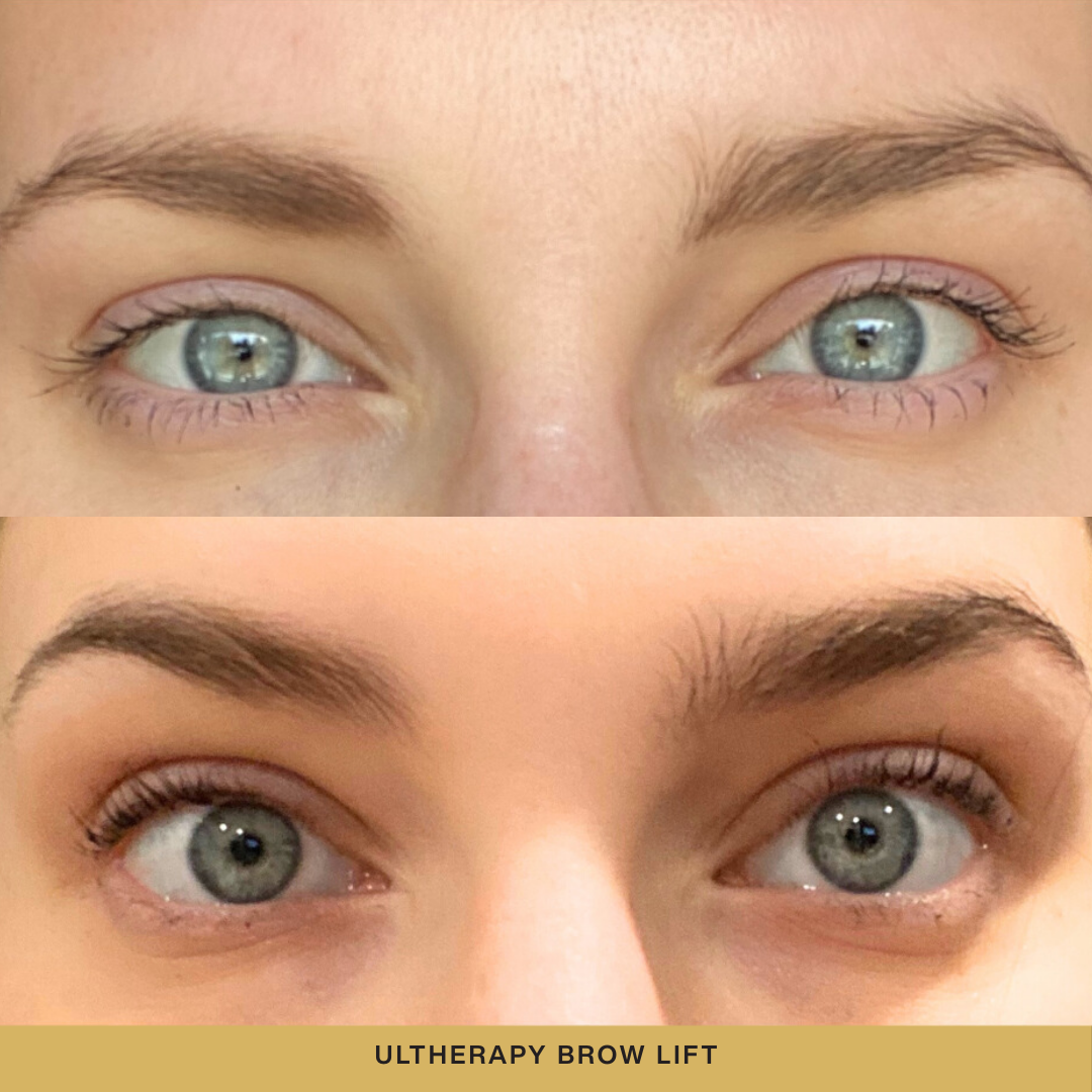 Ultherapy Brow Lift Before and After.png