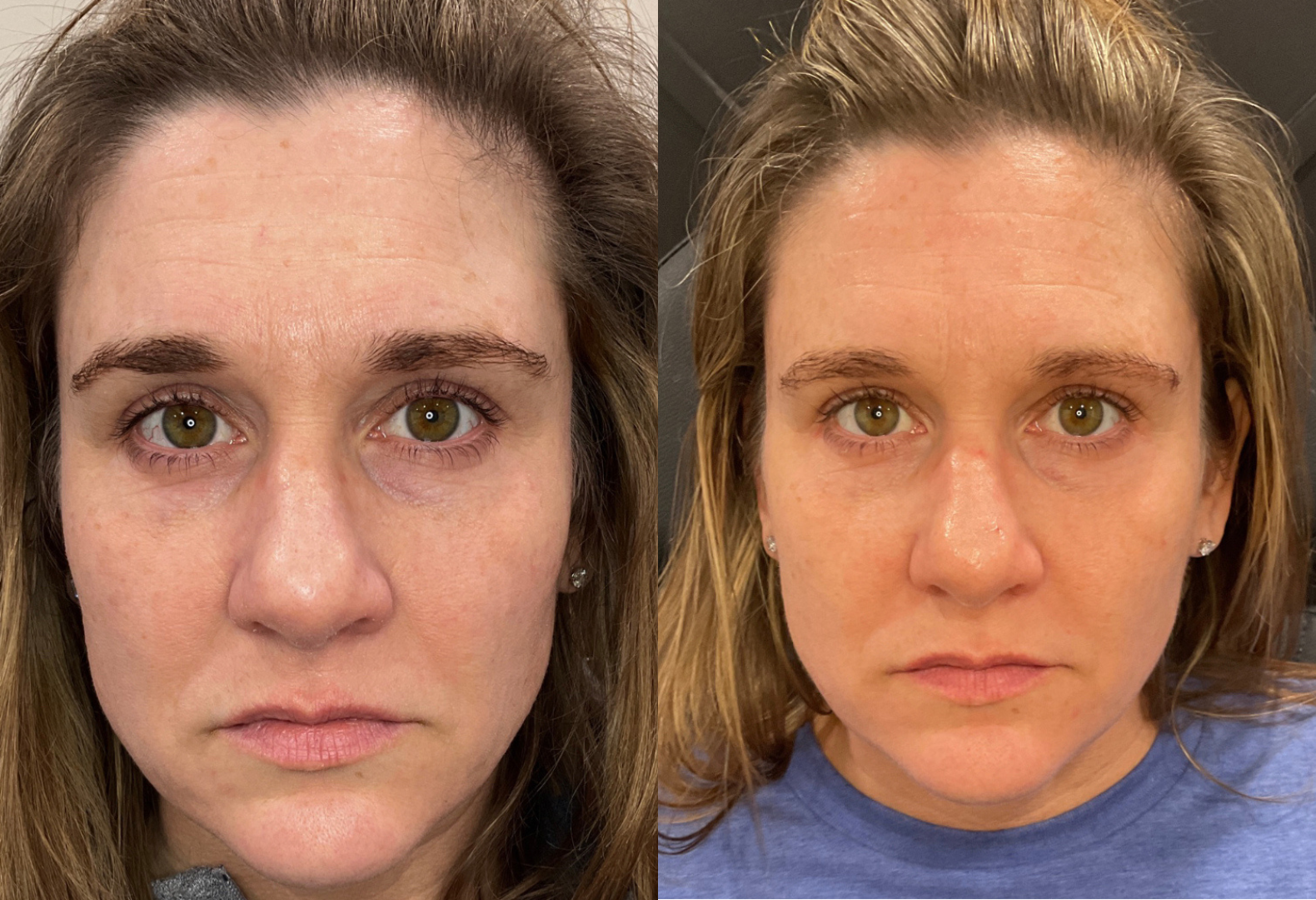 Pico laser facial before and after