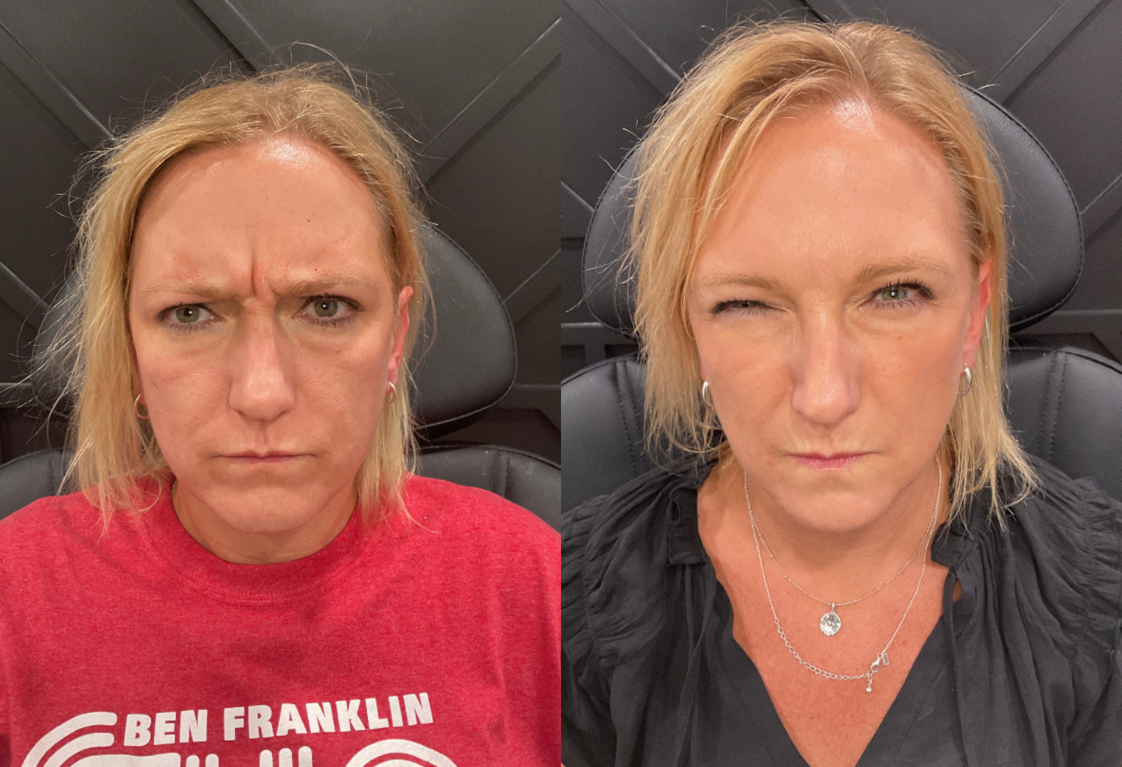 Botox before and after