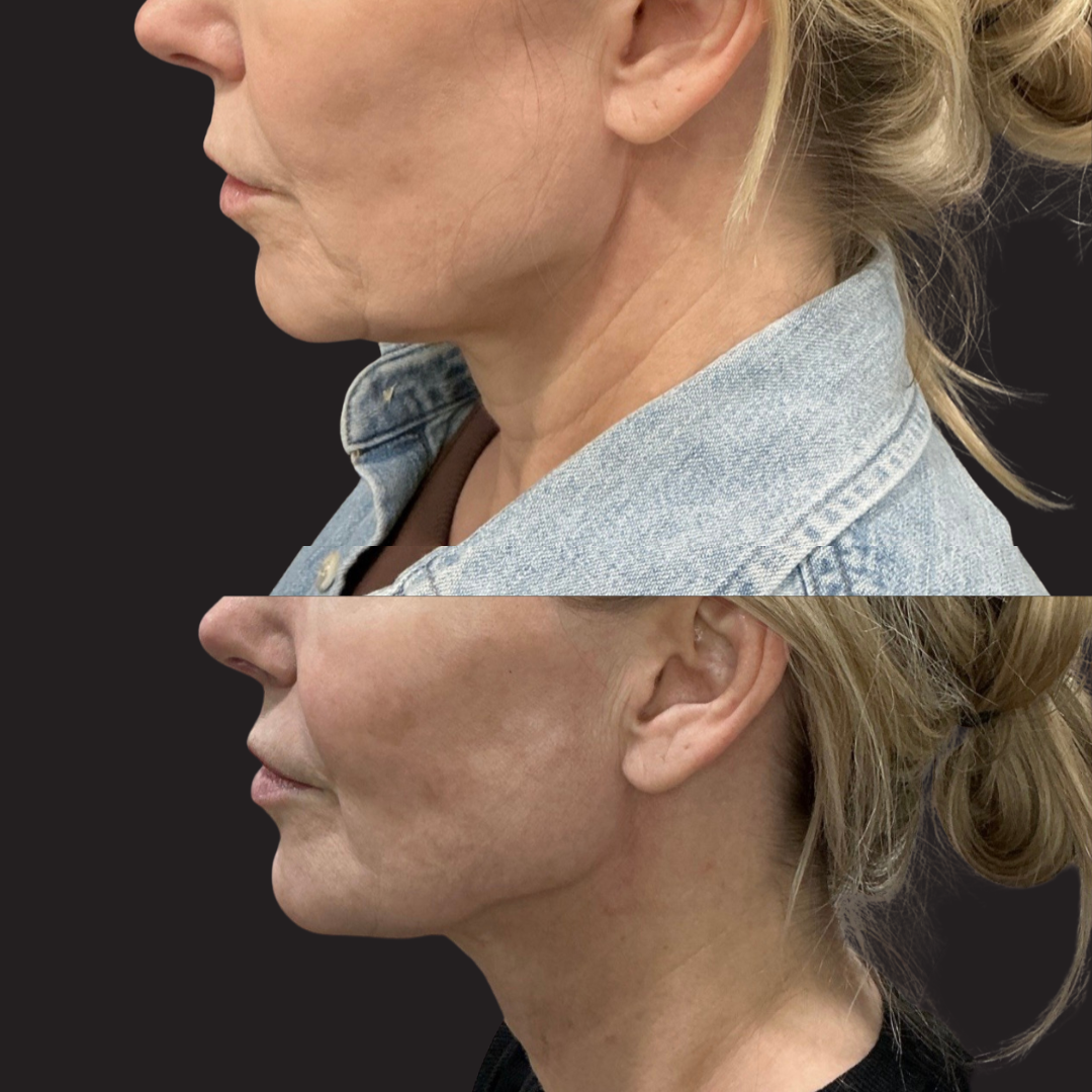 Before and after side-profile comparison showing improved jawline definition and neck skin tightening following iLaser 1940 Sculpt treatment.