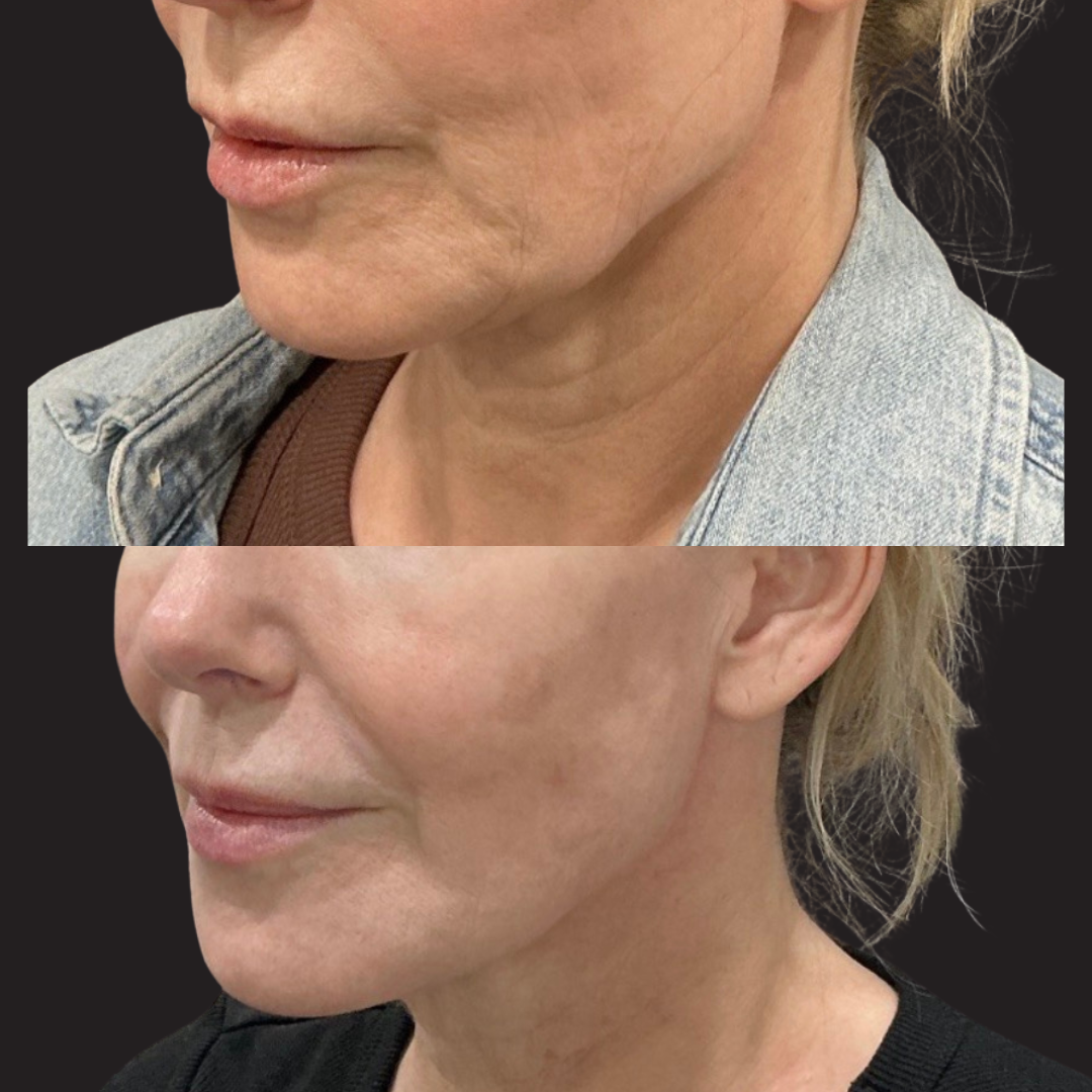 Before and after side-profile comparison showing jawline and neck contour improvement following iLaser 1940 Sculpt treatment