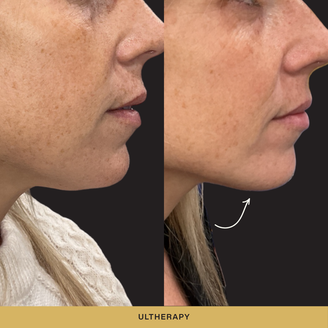Ultherapy Before and After.png