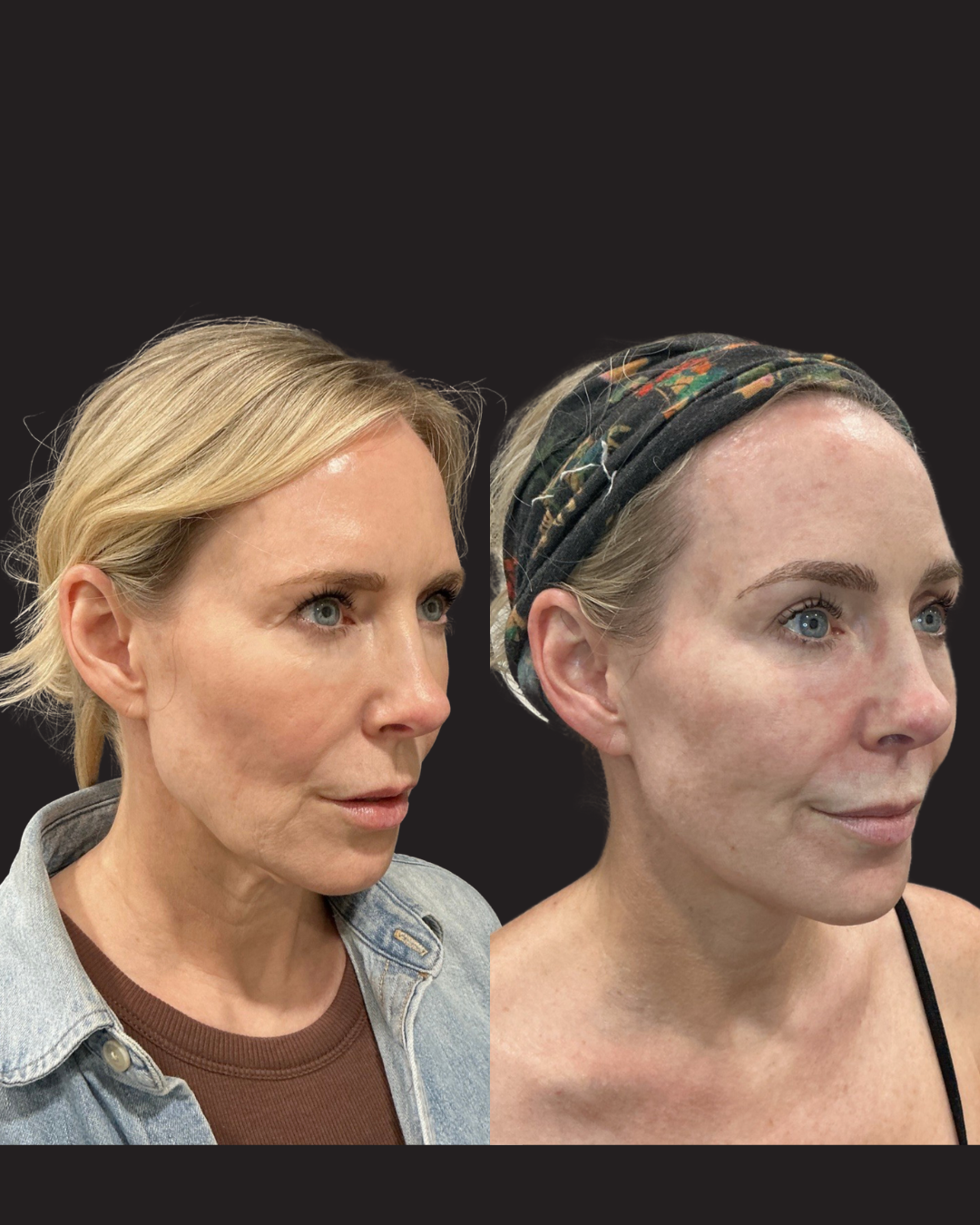 Before and after side-profile comparison showing jawline and neck contour improvement following iLaser 1940 Sculpt treatment