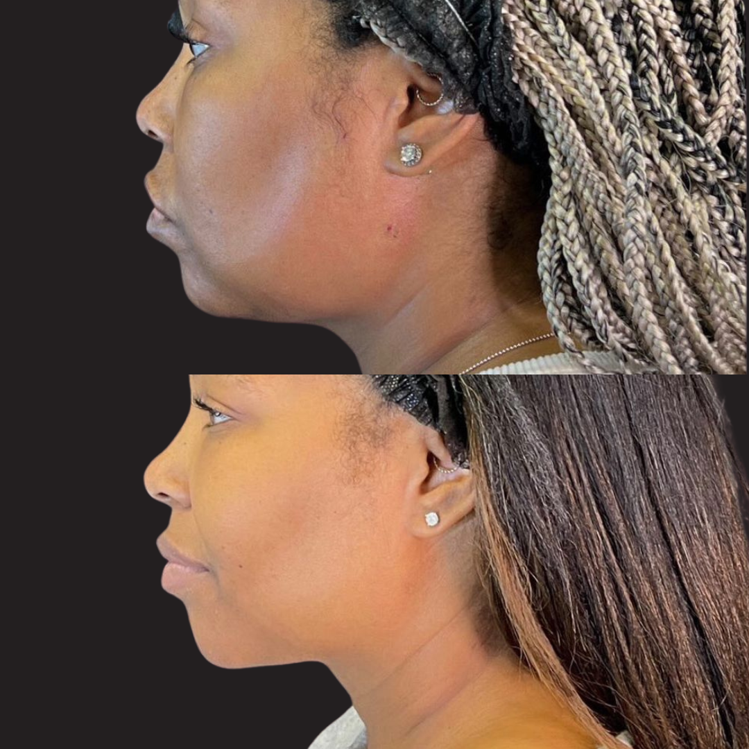 Before and after side-profile comparison showing improved chin and jawline contour following iLaser 1940 Sculpt treatment.