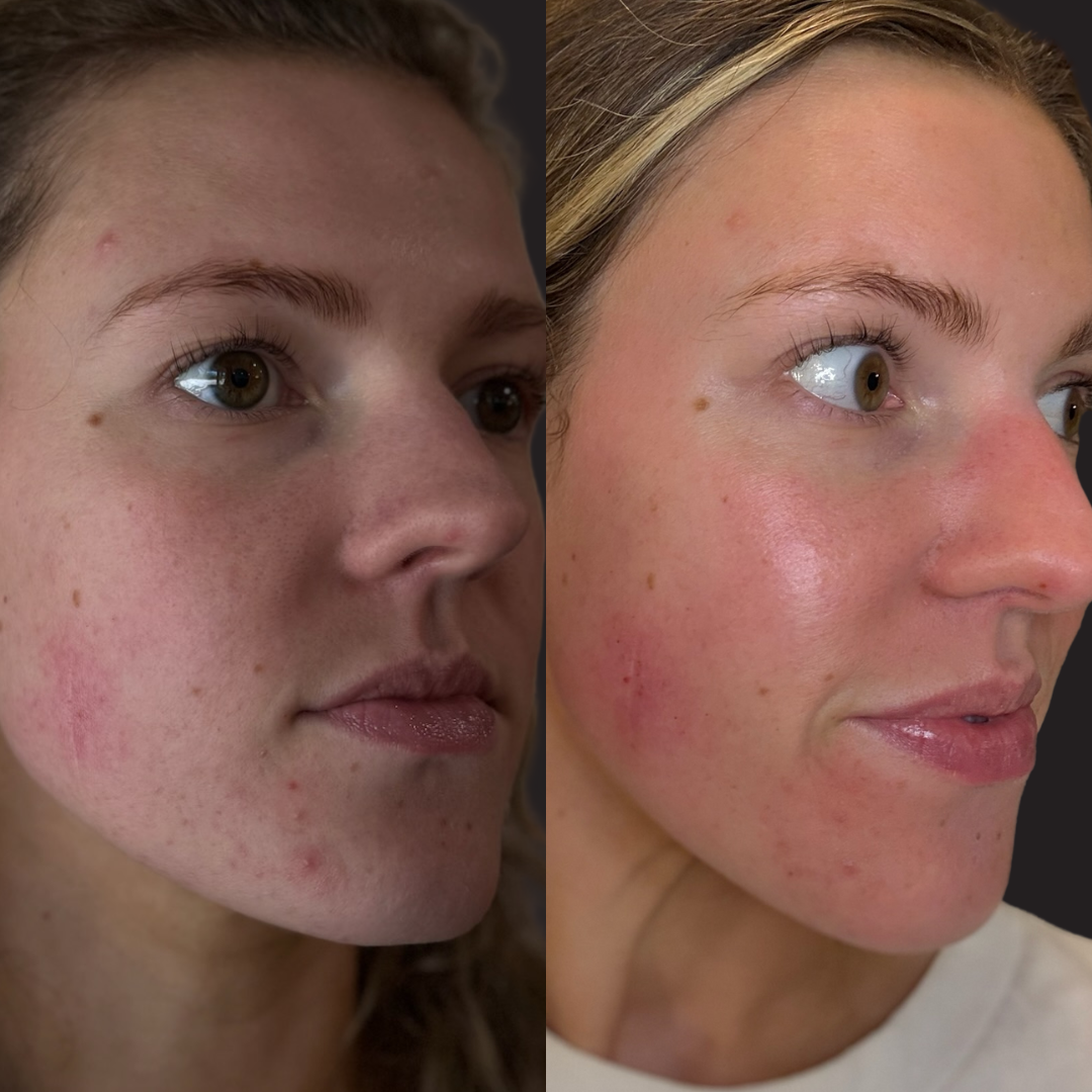 PDRN SkinPen Microneedling Before and After.png