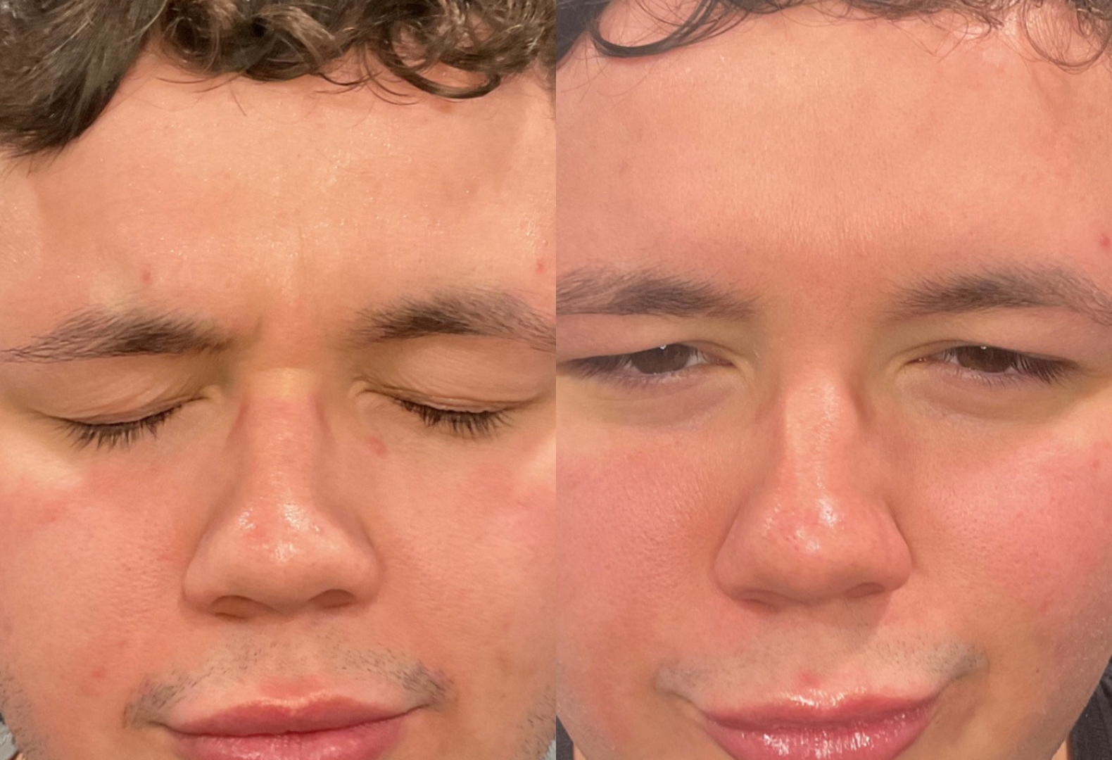 Botox before and after