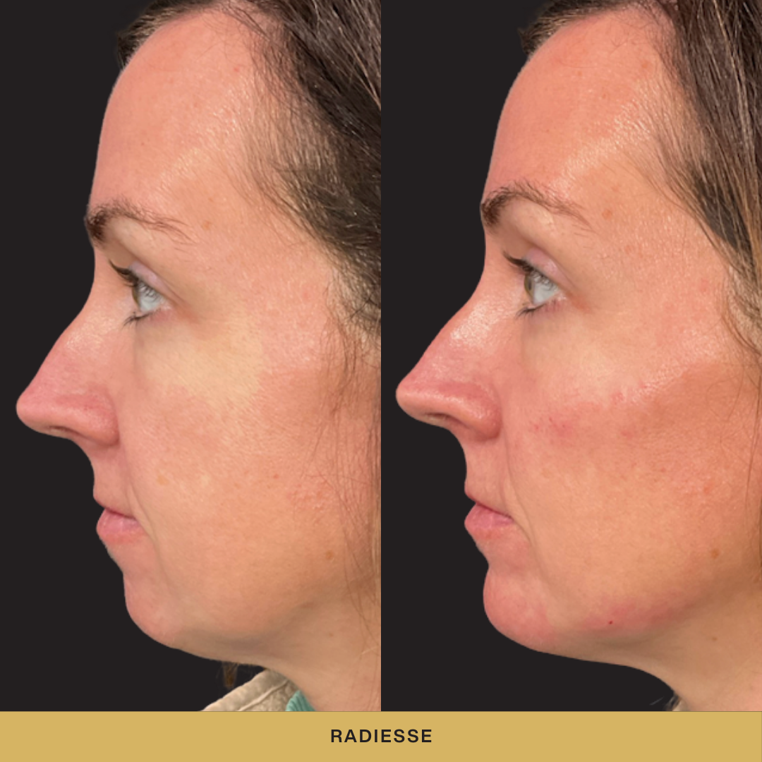 Radiesse Before and After.png