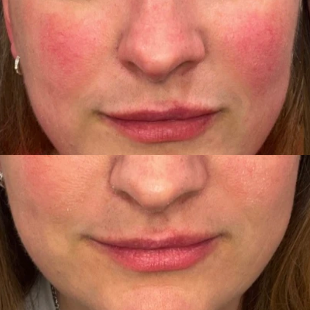 IPL Before and After