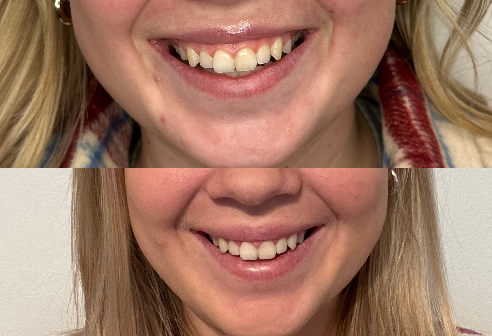 Lip flip before and after