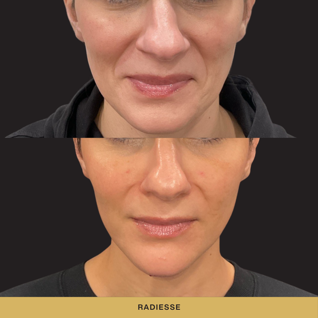 Radiesse Brow Lift Before and After.png