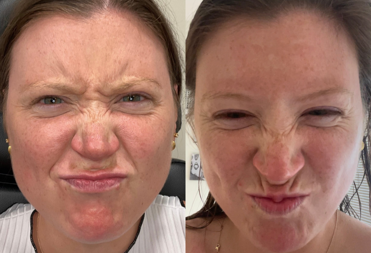 Botox before and after