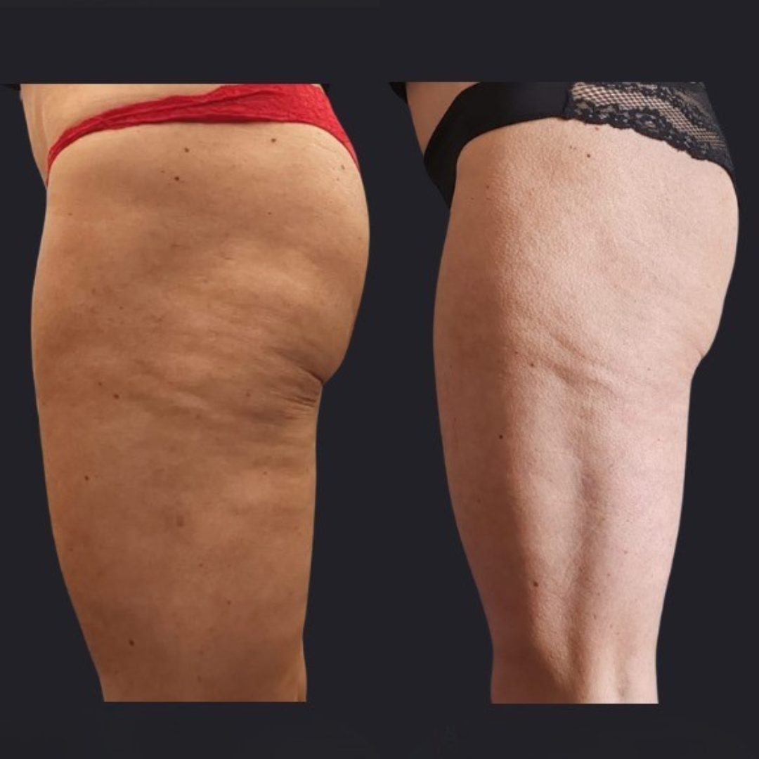 Before and after rear-view comparison of the thigh and buttock area showing smoother skin texture and reduced cellulite appearance after iLaser 1940 Sculpt treatment.