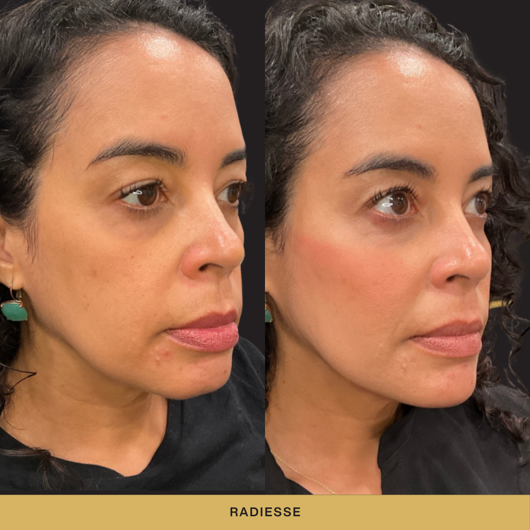 Radiesse Before and After.png