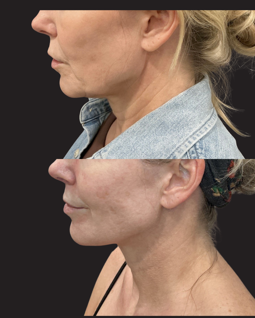Before and after side-profile comparison showing improved jawline definition and neck skin tightening following iLaser 1940 Sculpt treatment.