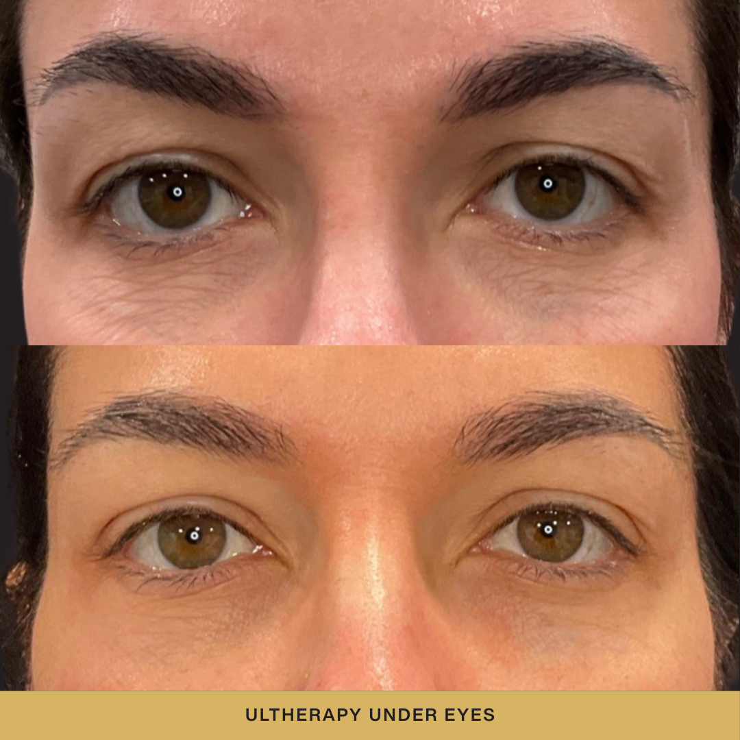 Ultherapy Under Eyes Before and After.png