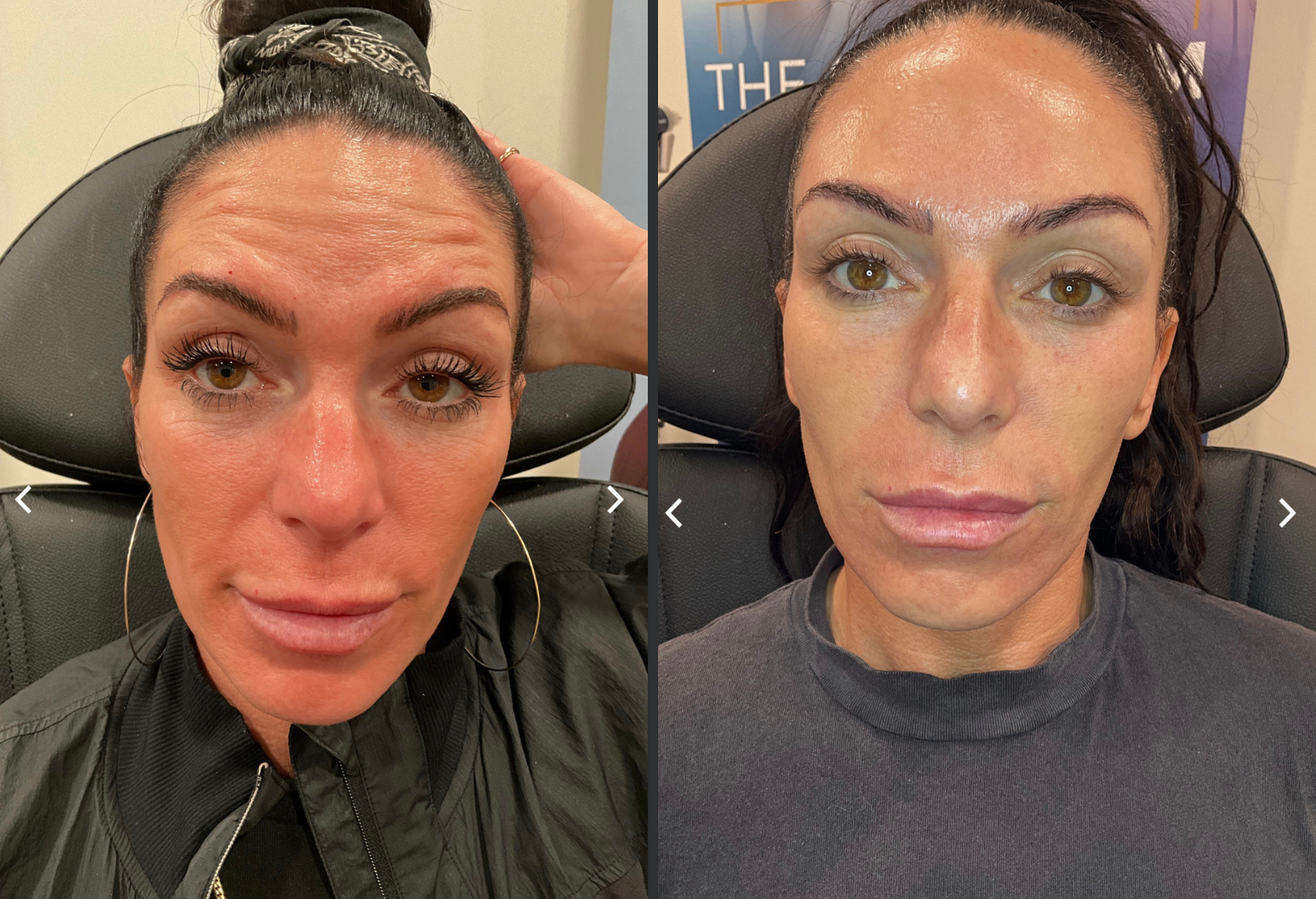 Botox before and after
