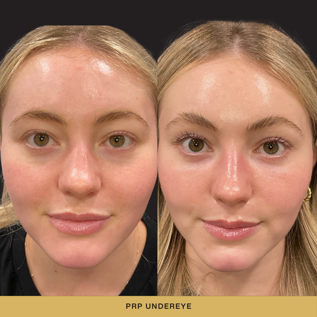 PRP Under Eye Before and After .png