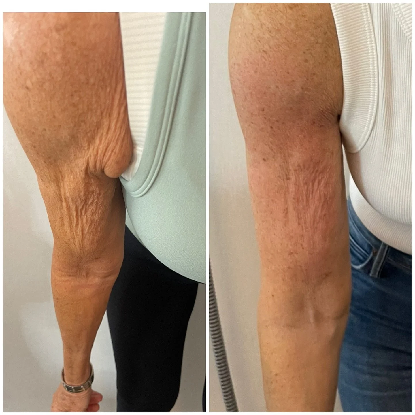Look at these amazing results using #lipofirm - 8 sessions of lipofirm skin tightening and muscle toning. Our lovely client couldn&rsquo;t be happier with the results&hellip;. There is still time to shape and tone before the festive season. 🎄💪🏼
Co