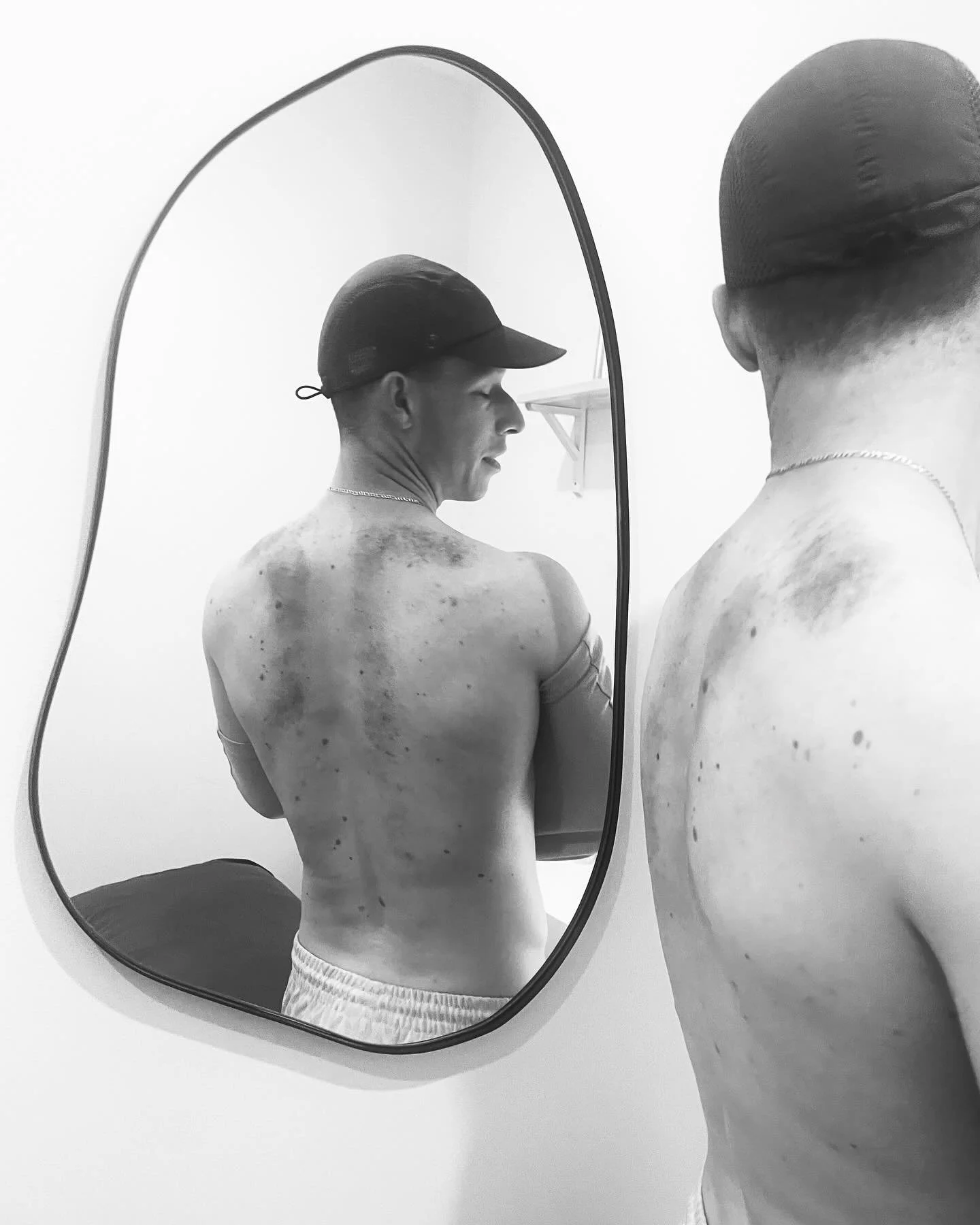 Gua Sha ❤️

I love nothing more than when patients want to &ldquo;see how much stagnation they have&rdquo;. While Gua Sha can look gnarly, it feels pretty bloody good. Using nearly anything with a rounded edge we simply scrape along areas of tightnes