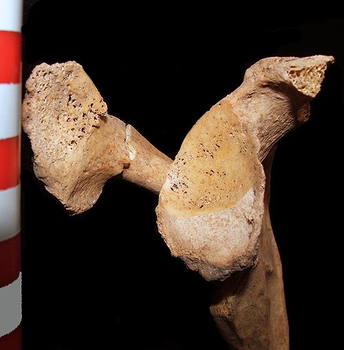 TR2_eburnation at glenoid and acromion.jpg
