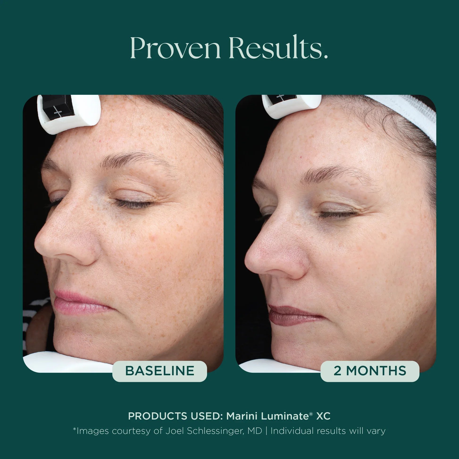 MSS26_Shopify_ProductPage_Before_Afters_DISCOLORATION_042726__DISCOLOR-MariniLuminateXC-1.jpg.webp