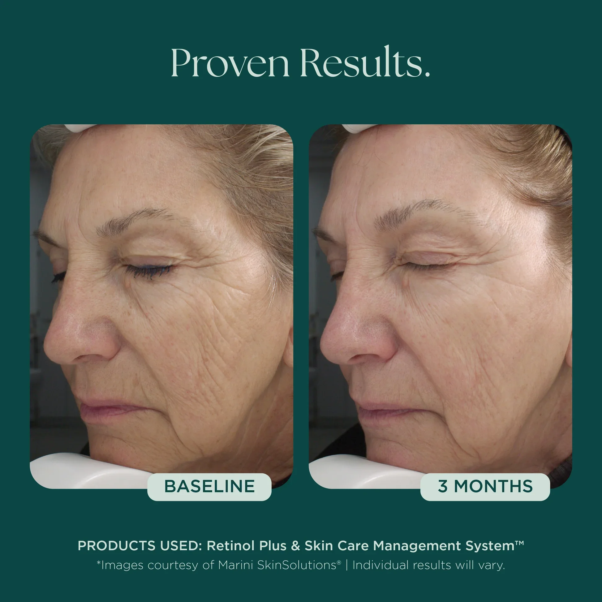 MSS26_Shopify_ProductPage_Before_Afters_FineLines_Wrinkles_042726__WRINKLES-8003.jpg.webp