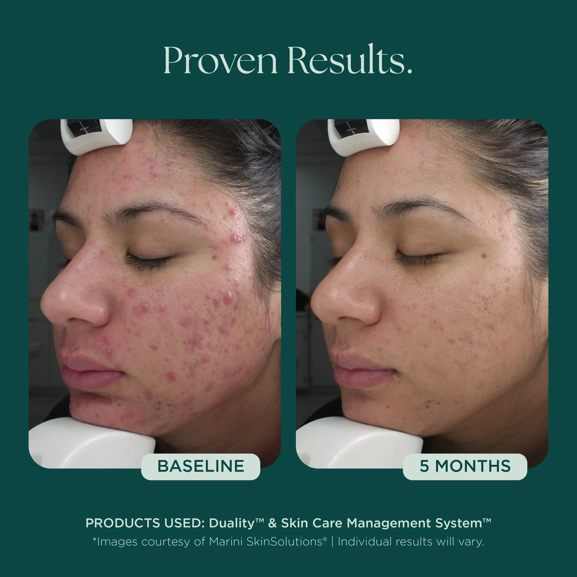 MSS26_Shopify_ProductPage_Before_Afters_ACNE_042726__ACNE-8008.jpg.webp