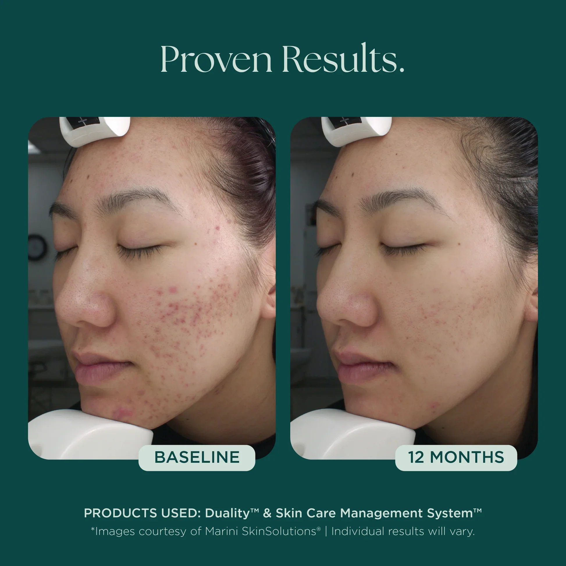 MSS26_Shopify_ProductPage_Before_Afters_ACNE_042726__ACNE-8007.jpg.webp