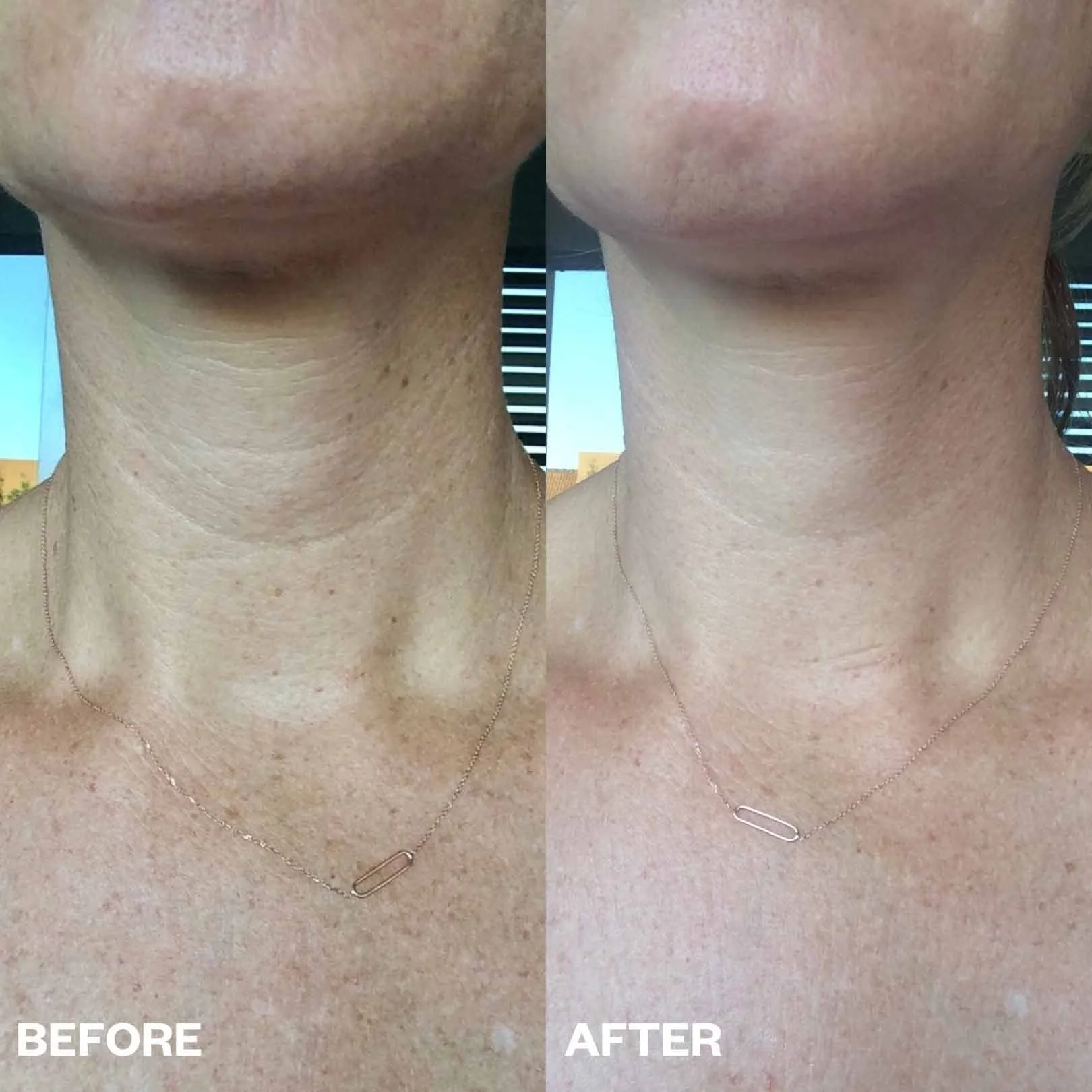 WS102 Neck Wrinkle Patch 4.jpg