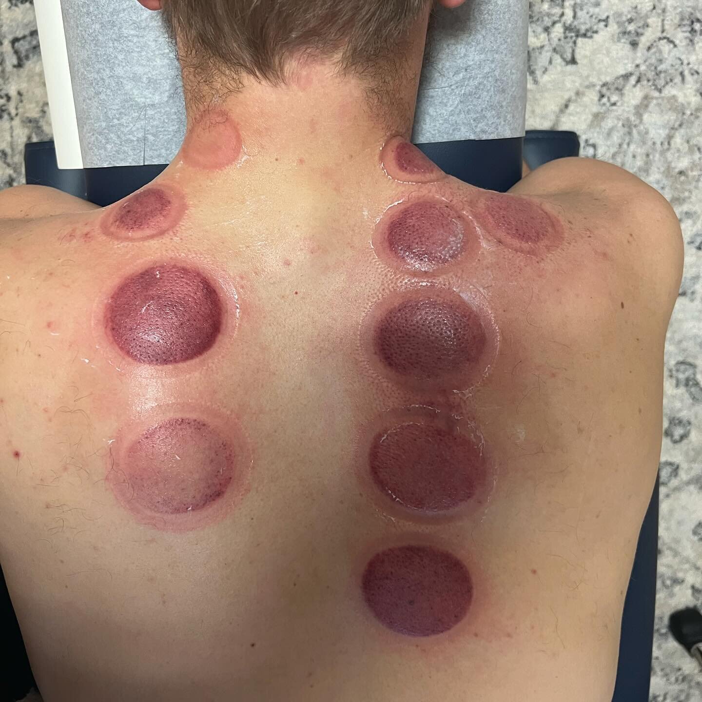 Cupping therapy provides several potential benefits for athletes (athlete being weekend warriors, collegiate level, high school, and simply people moving their body) 💪🏻🏃🏻⁣
⁣
Benefits include: ⁣
⁣
☑️ Pain Relief: alleviates muscle soreness, tightn