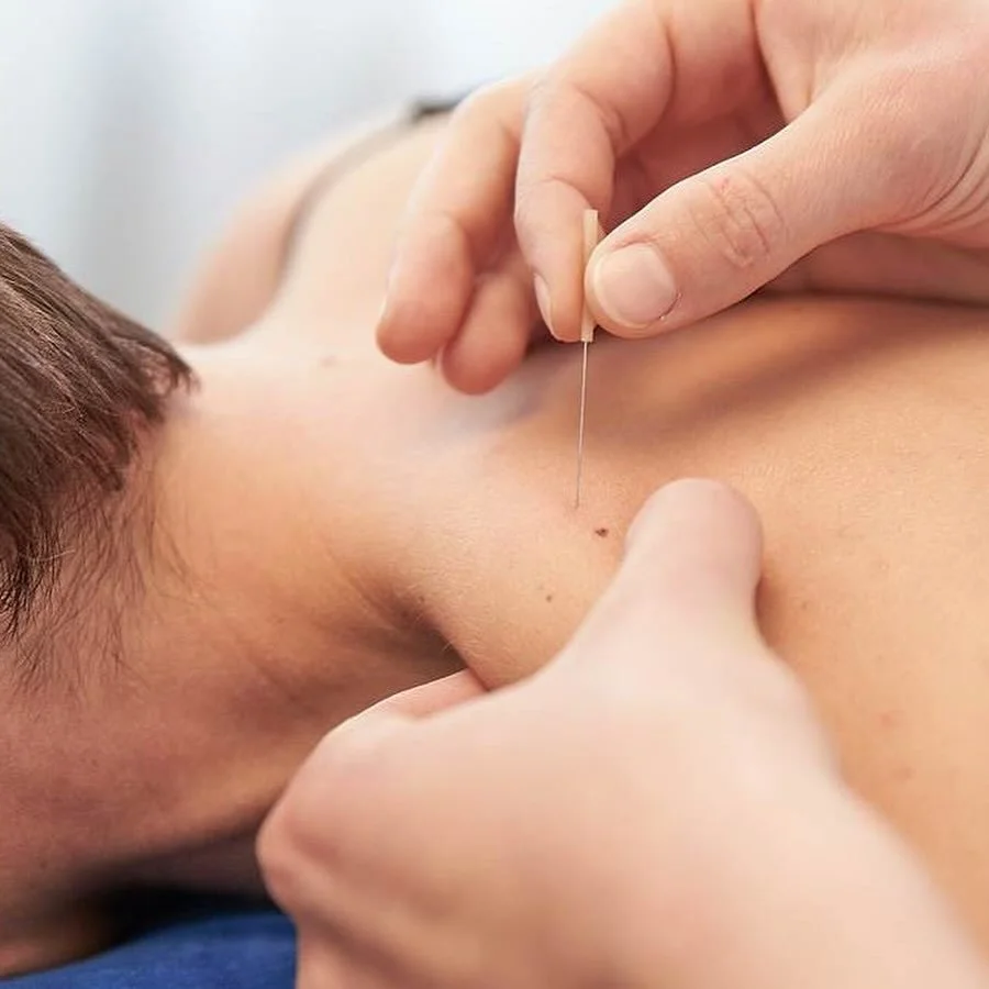 Have you tried dry needling? ⁉️

Dry needling is a therapeutic technique used to treat myofascial pain and trigger points ‼️ It involves inserting thin, sterile needles into specific muscle areas to relieve pain and improve function 💪🏻

Benefits of