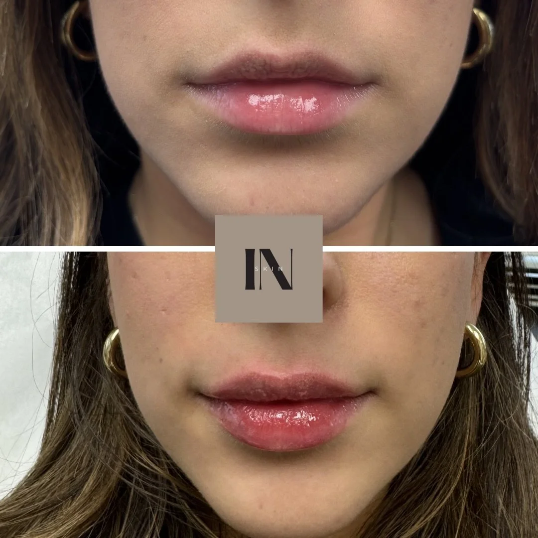 A little Valentine&rsquo;s Day pout by injector @ariel.inskin 🫶🏽💗

#lipfiller #valentinesday #valentine
