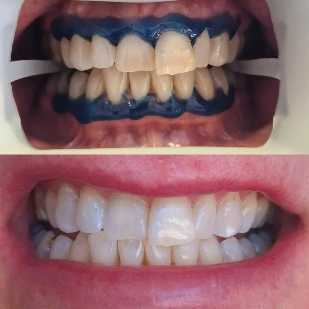 Sensitivity? Don&rsquo;t know her!

This lovely client had experienced sensitivity with cosmetic Teeth Whitening before so we insured her safety and comfort throughout both her initial and follow-up treatment. As you can see not only did she have ama