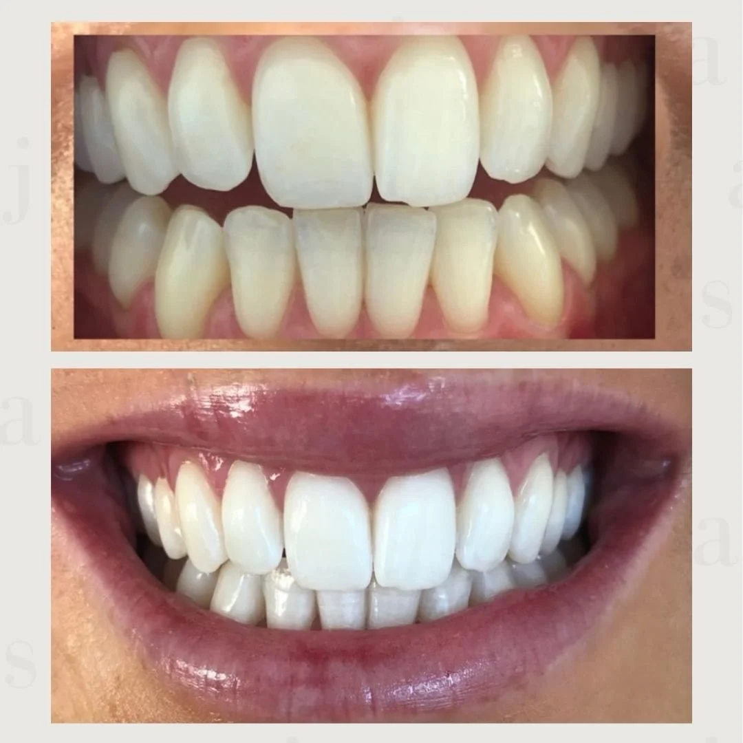 Struggling with stubborn stains from tea, coffee, or red wine? 

We get it &ndash; they can leave their mark. But don&rsquo;t worry, we&rsquo;ve got you covered! ✨

Our Signature Teeth Whitening Treatment is designed to target those tough stains and 