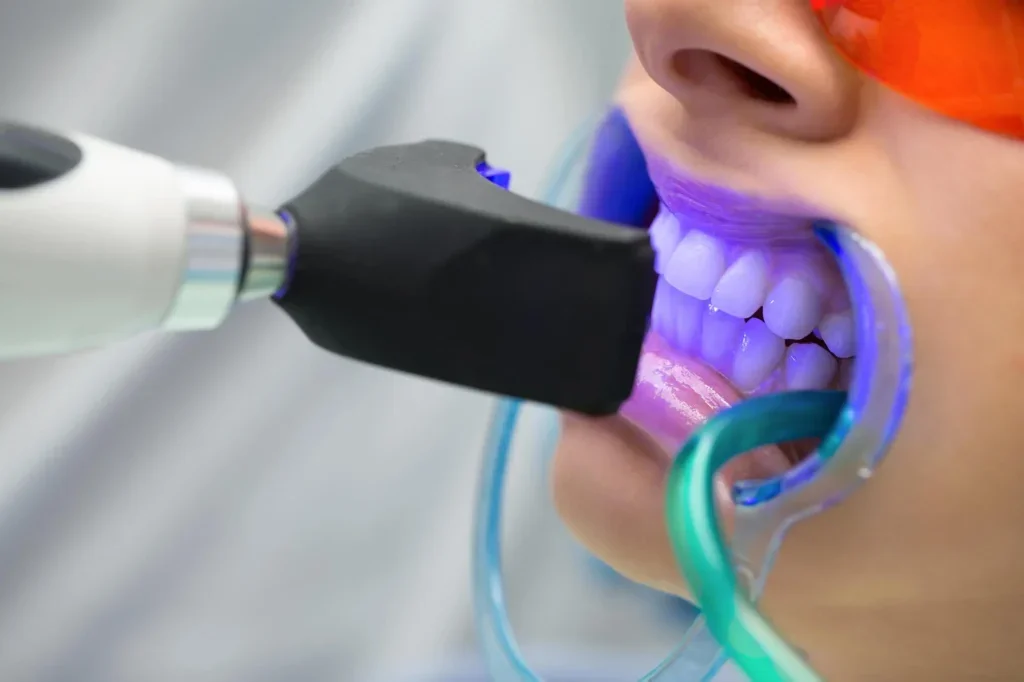 A dental patient undergoing a teeth whitening procedure with a bright blue light emitted from a device held by a dental professional. The patient is wearing protective glasses and has a dental mouthpiece.