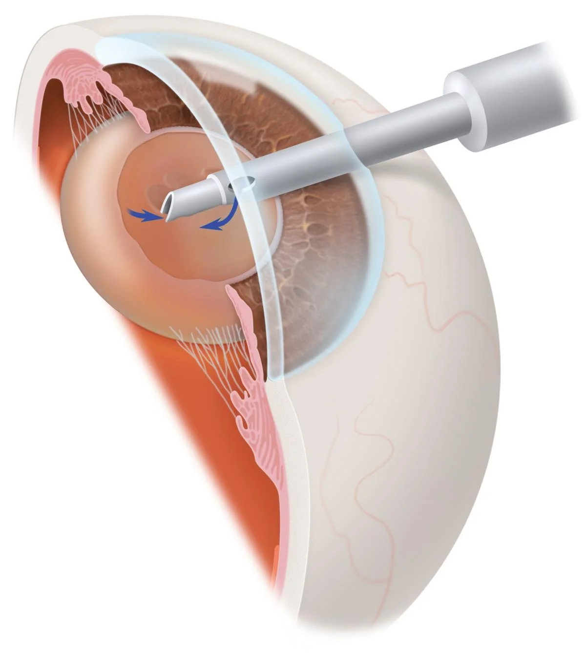 &nbsp;How Advanced Intraocular Lenses Can Reduce Your Need for Glasses After Cataract Surgery