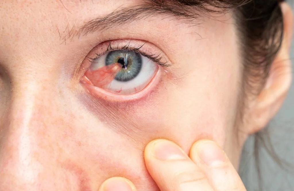 Pterygium Recurrence: Can It Come Back?