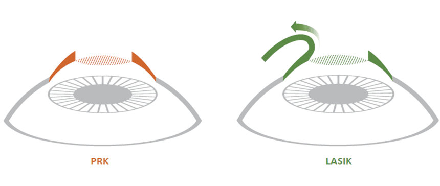 LASIK Procedure Overview |  surgeon removes